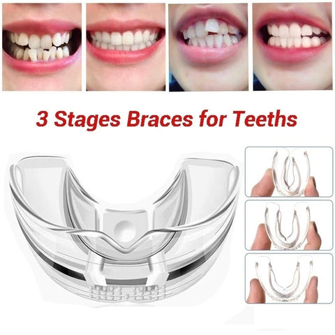 Image of Dental Orthodontic Braces 3 Stages Teeth Alignment